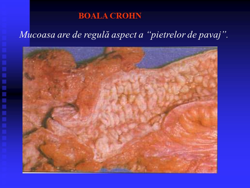 BOALA CROHN Mucoasa are de regulă aspect a “pietrelor de pavaj”.